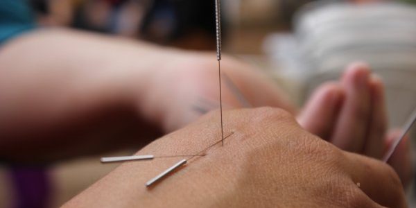 acupuncture-6324472.600×0